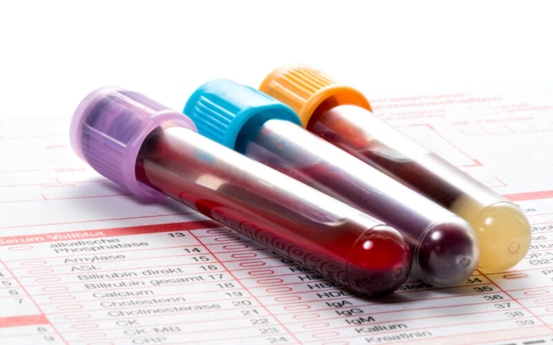 Le analisi del sangue: un importante strumento di prevenzione.