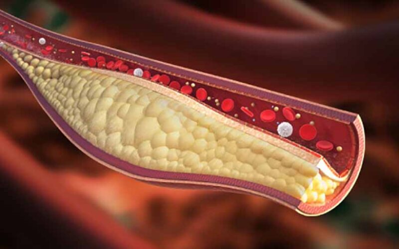 Colesterolo sotto Controllo: Guida Completa alle Statine per una Vita Più Salutare